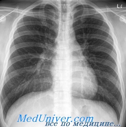 Cauzele extinderii umbrei inimii, mediastinului pe roentgenograma