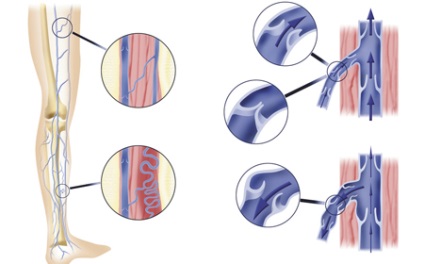 Cauzele bolii varicoase și consecințele ei