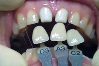 Principiile seturilor de construcții pentru selecția dinților din material plastic