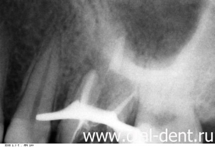 Canalul dintelui este ratat - tratamentul cu ajutorul unui microscop va ajuta