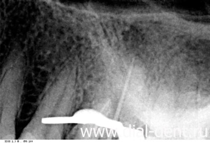 Canalul dintelui este ratat - tratamentul cu ajutorul unui microscop va ajuta