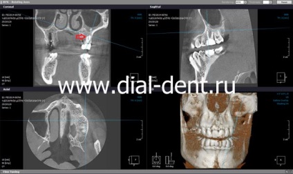 Canalul dintelui este ratat - tratamentul cu ajutorul unui microscop va ajuta