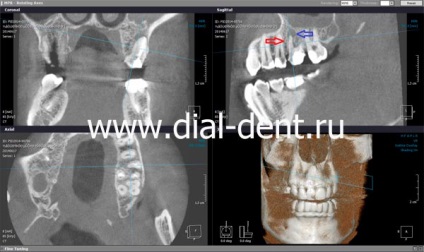 Canalul dintelui este ratat - tratamentul cu ajutorul unui microscop va ajuta