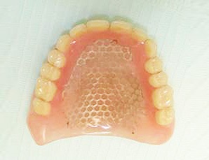 A teljesen fogatlan állkapocs protézise az implantátumok használatával (fogak beültetése) A teljesen fogatlan állcsont protézise az implantátumok használatával