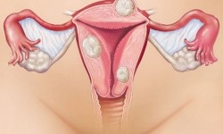 Contraindicații pentru miomul uterin, care nu se poate face