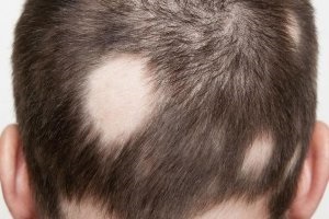 Soiuri de alopecie, cauzele apariției lor - portal medical «»