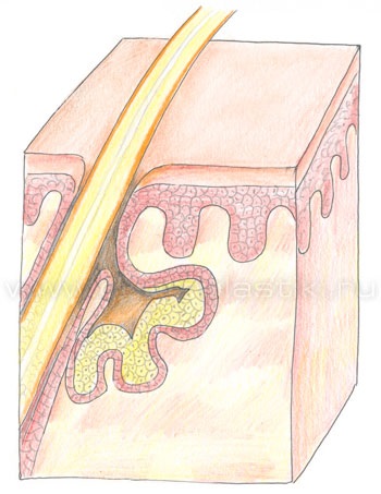 Seborrhea, tratamentul seboreei