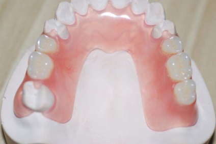 Proteză detașabilă pentru maxilarul superior fără proteză parțială în absența dinților, specii