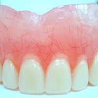 Proteză detașabilă pentru maxilarul superior fără proteză parțială în absența dinților, specii
