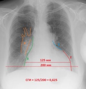 Anatomia cu raze X de inima si conditiile manifestate de expansiunea umbrei cardiace, a doua opinie