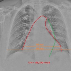 Szív röntgen-anatómia és a szívelégtelenség kiterjesztésével manifesztált állapotok, egy második vélemény