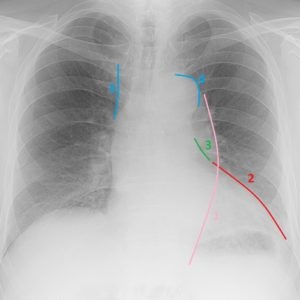 Anatomia cu raze X de inima si conditiile manifestate de expansiunea umbrei cardiace, a doua opinie