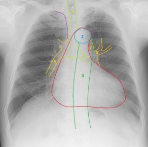Anatomia cu raze X de inima si conditiile manifestate de expansiunea umbrei cardiace, a doua opinie