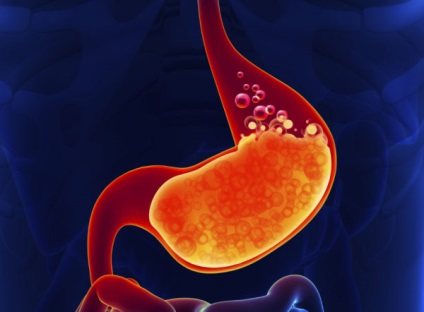 Simptomele și tratamentul bolilor zhkt, atunci când există o aciditate crescută a stomacului