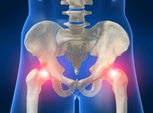 Simptomele și tratamentul coxartrozei articulației șoldului