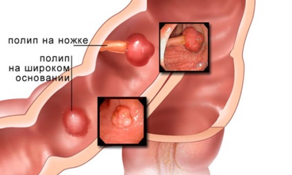 Simptomele polipilor din stomac