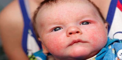 A csecsemő szeme felborulása - érdemes aggódni