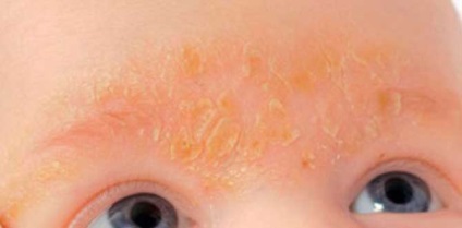 O erupție cutanată în jurul ochilor unui copil - merită îngrijorată