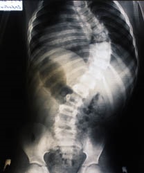 Scoliosis a gyermekek agyi bénulásában (dtsp)