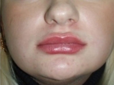 Свирки за устна подкрепление Отзиви свирки fulips, видео по заявка, подмладяване на кожата