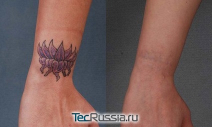 Îndepărtarea tatuajelor