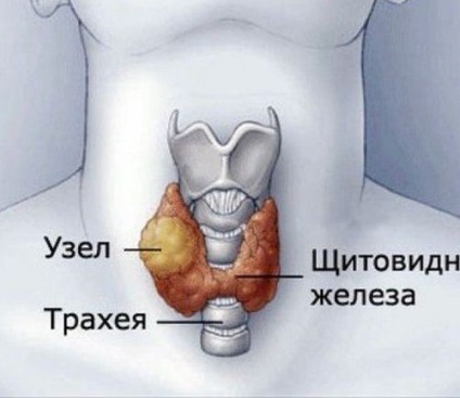 Noduli și chisturi ale glandei tiroide - intervenție chirurgicală pentru îndepărtarea nodulilor tiroidieni