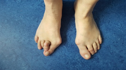 Care este diferența dintre gută și conuri pe picioare