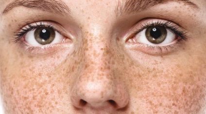 Freckles Ce știm despre ei, Journal of Health