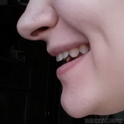 Foarte set maxilarului superior, nu pot vedea dintii de sus cu un zâmbet și vorbesc, este posibil pentru ceva