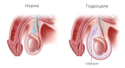 A csepegő testcse (hydrocele) azonnali kezelést kap az Astrakhan klinikáin