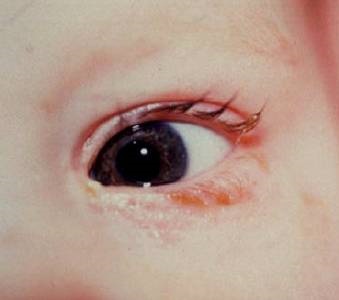 Bolile congenitale ale canalelor lacrimale