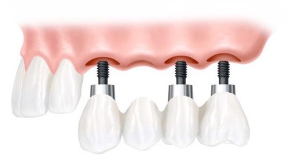 Caracteristici ale dinților inserați din dinți protetic