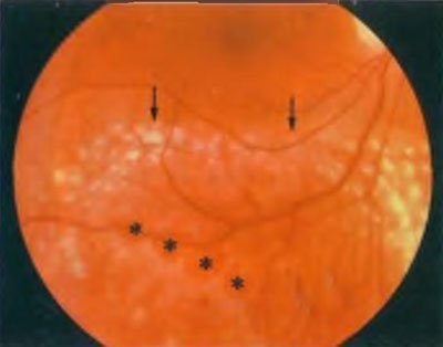 Boli ale periferii retinoschisiei degenerative a retinei