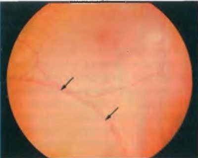 Заболявания на периферната ретината дегенеративни Ретиносхиза