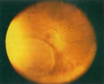 Boli ale periferii retinoschisiei degenerative a retinei