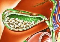 Gallstone boală de cauză, tratamentul de zhkb, calculi biliari