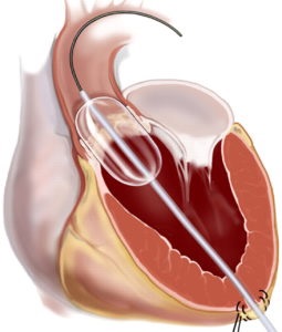 Stenoza stenozei aortice de diagnostic și tratament