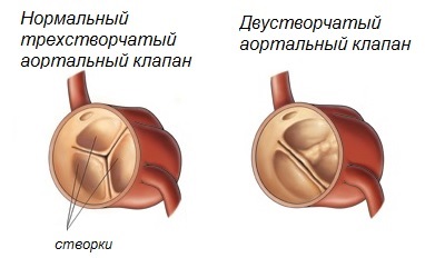 Stenoza stenozei aortice de diagnostic și tratament