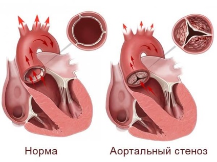 Stenoza stenozei aortice de diagnostic și tratament