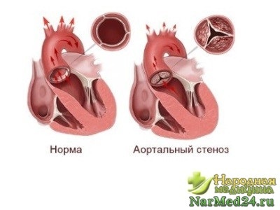 Aorta stenosis tünetei, szövődmények, kezelési módok