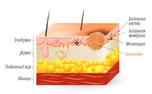 Pielea bazală a pielii - tratamentul, care este prognosticul