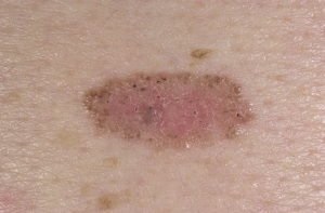 Pielea bazală a pielii - tratamentul, care este prognosticul