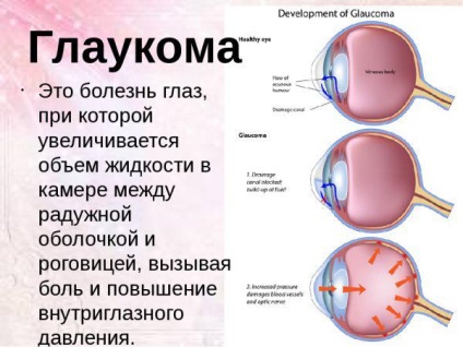 Ce este glaucomul, cauzele și consecințele acestuia, simptomele și tratamentul la adulți, debutul și