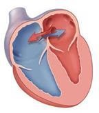 Septal defectul atrial