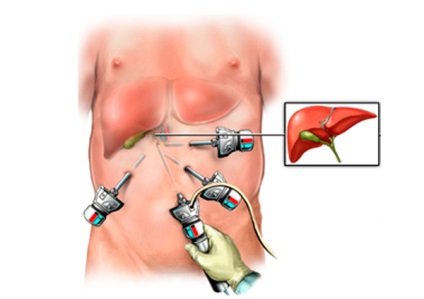 Dieta după operație pentru a elimina laparoscopia vezicii biliare și restricțiile dietetice
