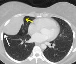 Tumorile benigne ale pleurei - cauze, simptome, diagnostic și tratament