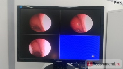 Endoscopia nazofaringei - 