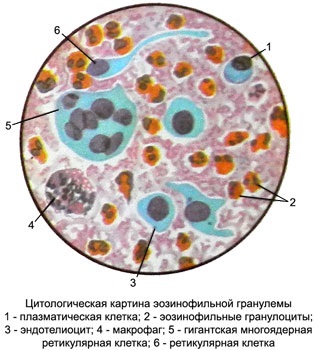 Granulomul eozinofilic