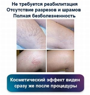 Echosclerotherapy (ehokontroliruemaya склеротерапия) разширени вени ревюта, характеристики, хода на процедурата