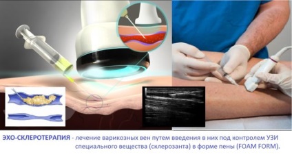 Echoclexoterapia (scleroterapia controlată cu ecou) a revizuirilor venei varicoase, caracteristici, procedura de procedură